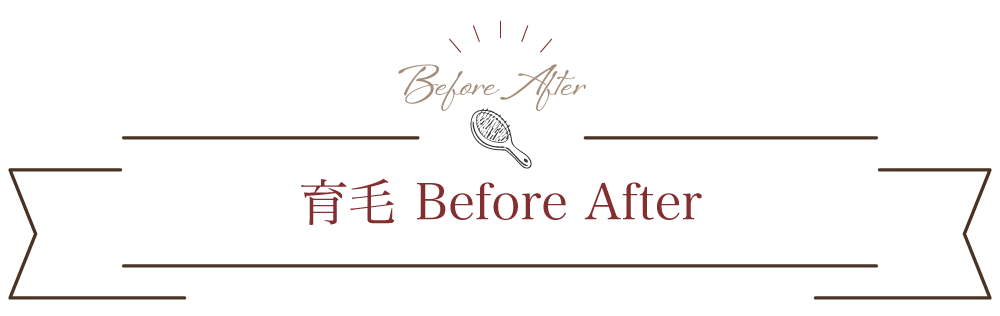 育毛 Before After